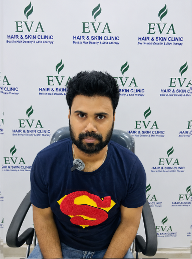 After hair transplant result 9
